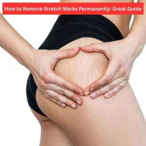 How to Remove Stretch Marks Permanently: Great Guide