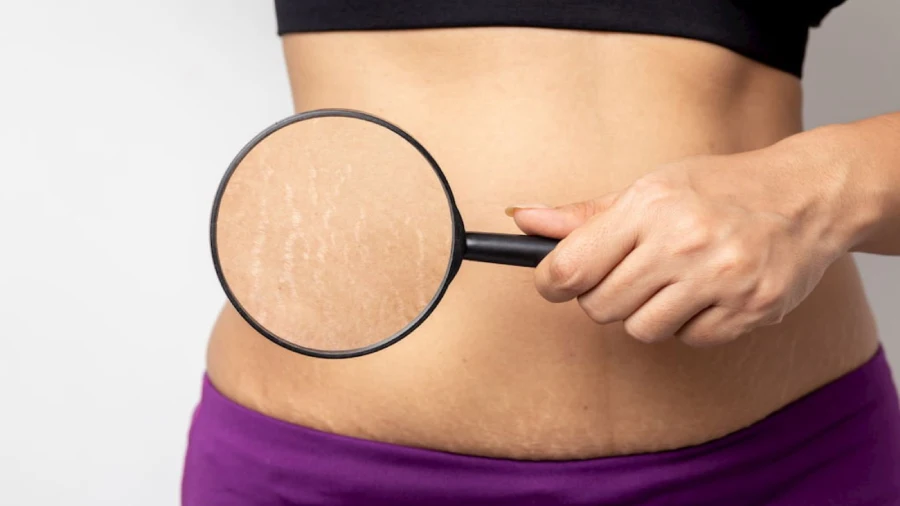 Natural and Complementary Approaches to Stretch Mark Management